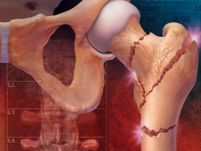 哪里逃？骨质疏松症新基因被揪出！治疗迎来新靶点